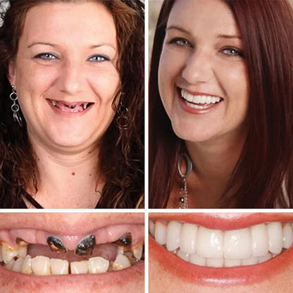 🌎Ends Today: 70% OFF! ⏰ Medical Full Denture with Strong Suctiond🦷Obtain American Dental Association (ADA) Certification
